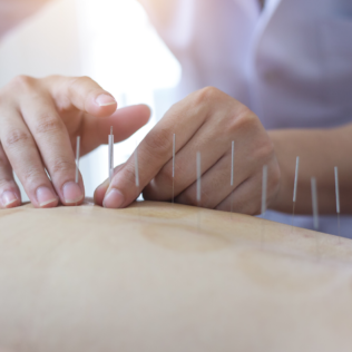 A person is using acupuncture needles on the back of their body.