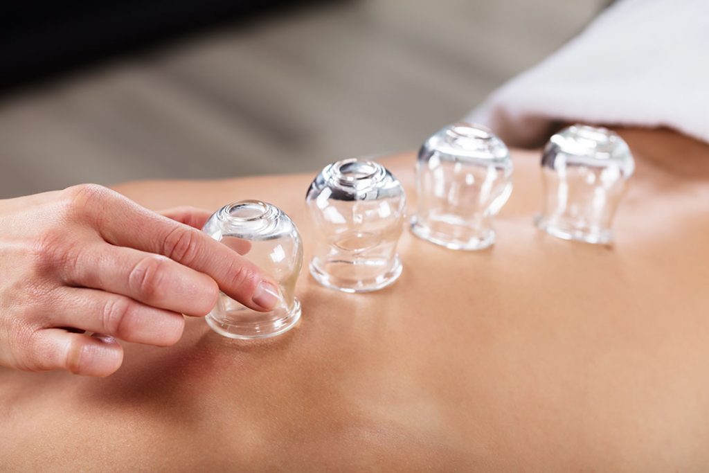 Cupping therapy session in progress with glass cups applied to a client’s back.